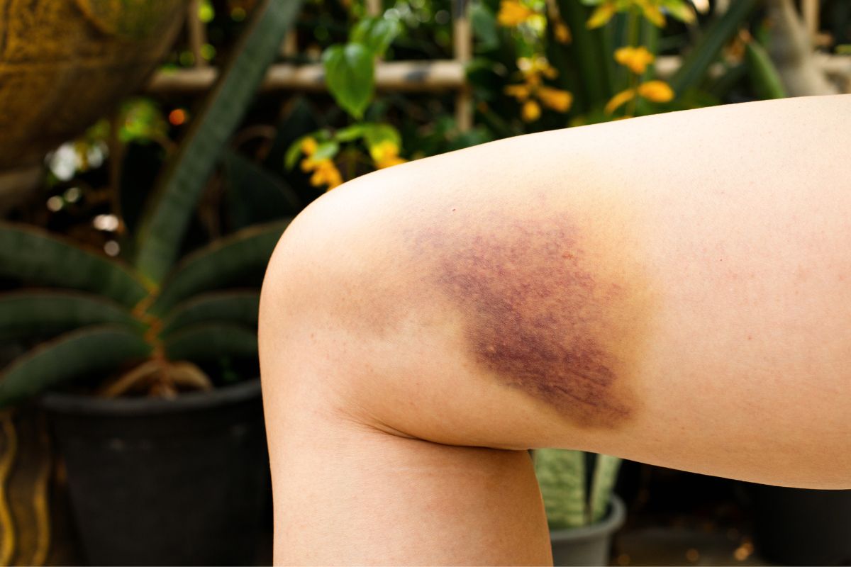 Гэмтэлтэй цус хуралт